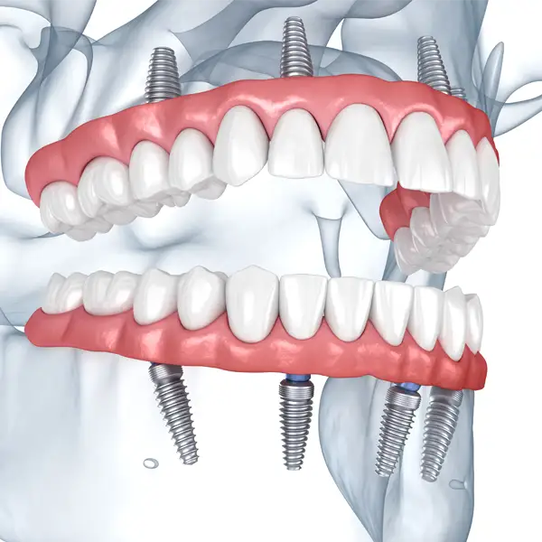 3d rendering of All-on-4 concept treatment