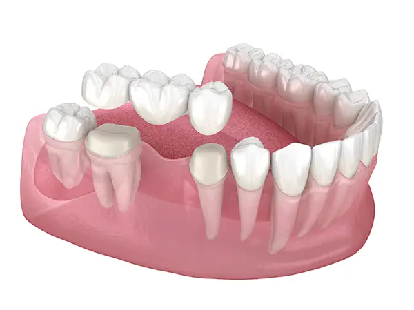 3D model of a dental bridge from Avery Dental Center 