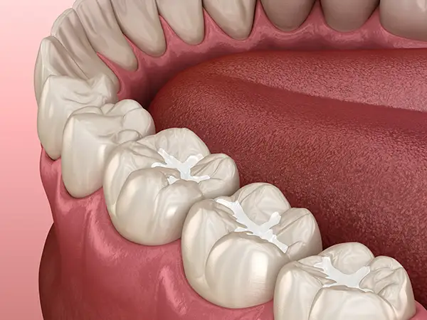 3D rendering of a dental filling from Avery Dental Center 