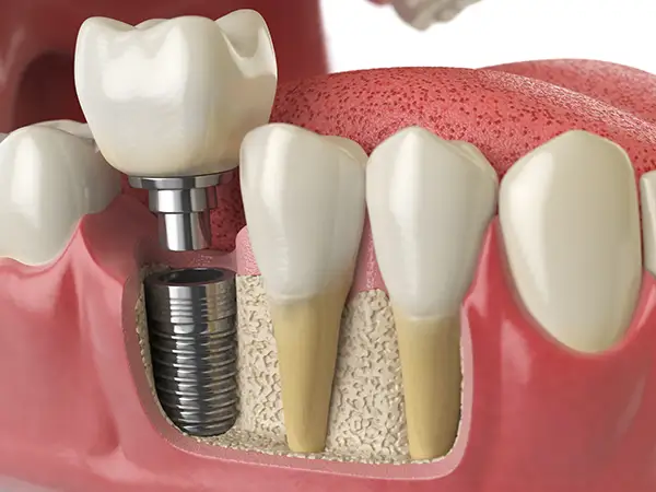 3D model of a dental implant from Avery Dental Center 