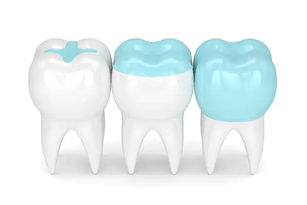 3D rendering of inlays and onlays from Avery Dental Center 