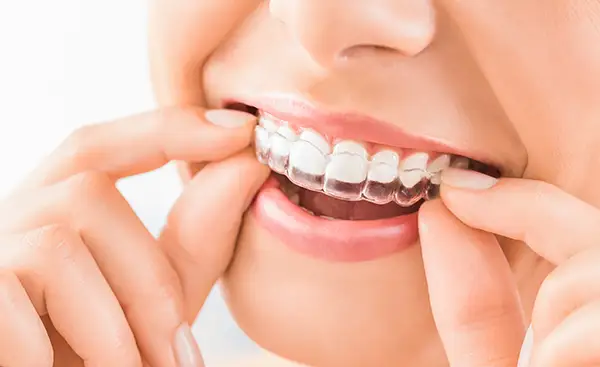 Woman putting on an Invisalign clear aligner at Avery Dental Center 