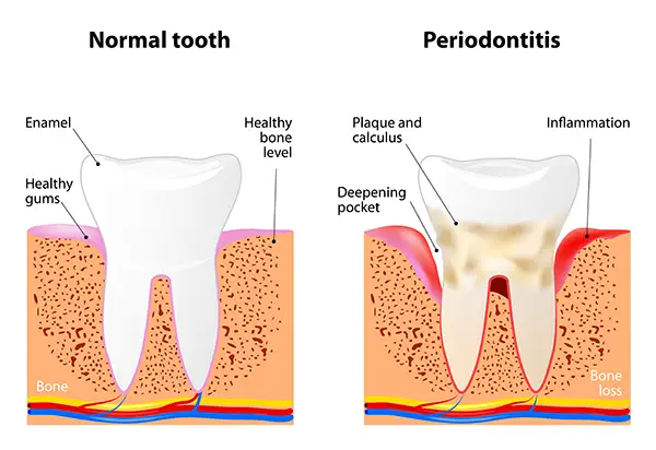 Diagram of gum disease showing a healthy gum on one side and an unhealthy one on the other