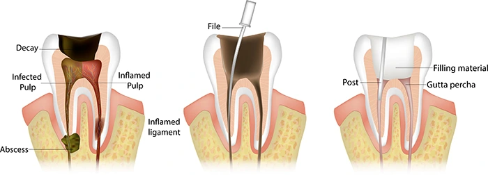 Detailed drawing of a root canal procedure