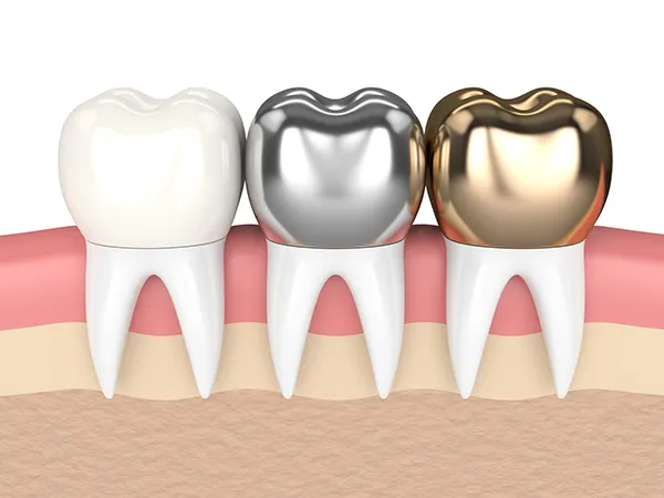 Three teeth with dental crowns made of different materials: porcelain, amalgam, and gold