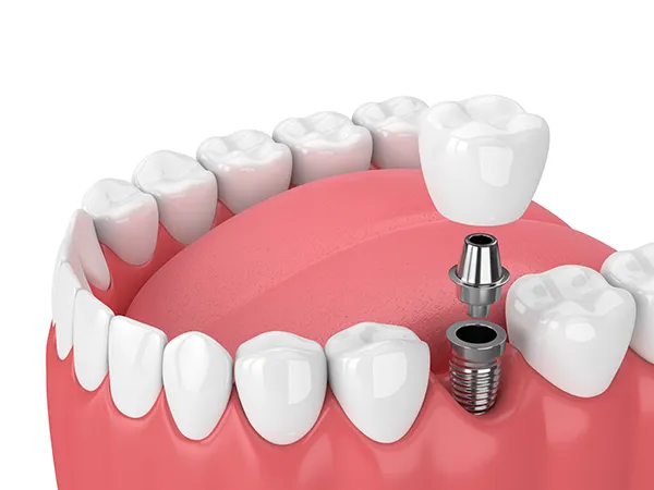 3D model of a dental implant