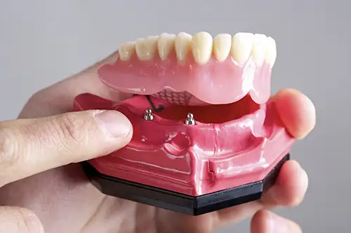 Image of a snap-in denture