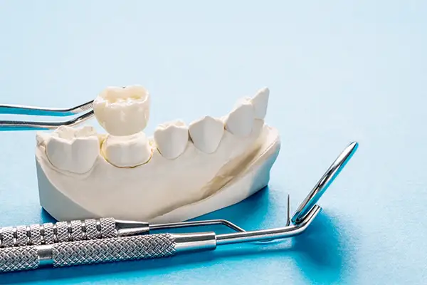 Close-up of a dental crown placed on a dental model, showcasing accurate fit and realistic tooth anatomy.