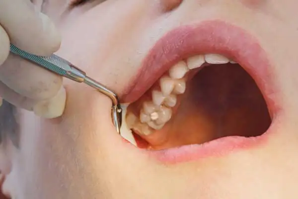 A dentist examining a patient's tooth cavity with a dental instrument before placing a filling, demonstrating the cavity treatment process.