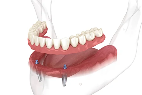 Problems with Snap-In Dentures